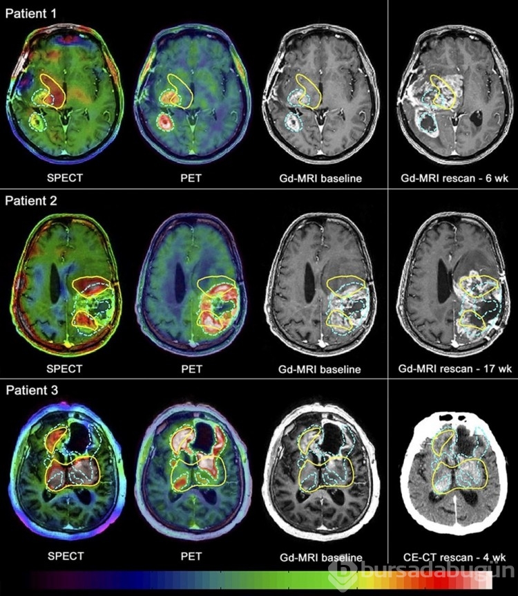 Kadınların Alzheimer'a erkeklerden daha yatkın olduğu keşfedildi