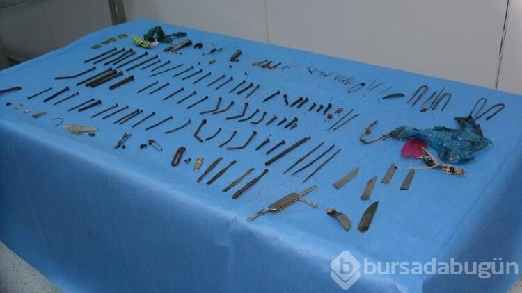 Doktorları şaşkına çeviren ameliyat:158 parça metal çıktı