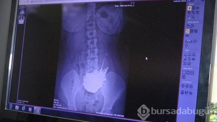 Doktorları şaşkına çeviren ameliyat:158 parça metal çıktı