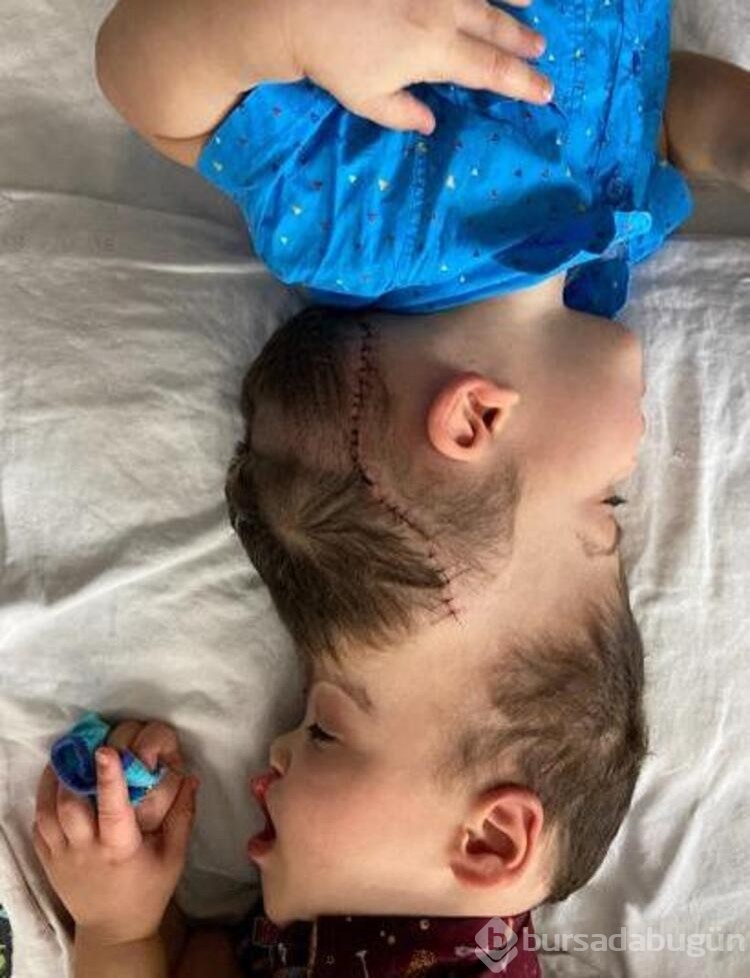 Yapışık ikizler sanal gerçeklikle ayrıldı! 