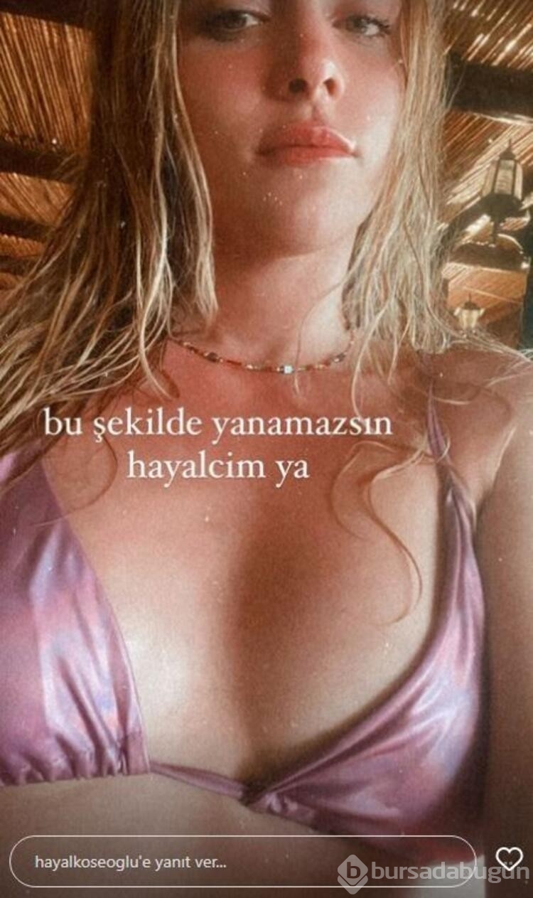 Hayal Köseoğlu tatilde fazla yandı