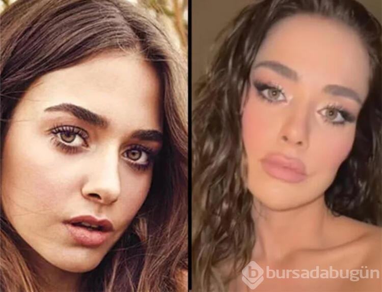 Bensu Soral estetik furyasına katıldı!