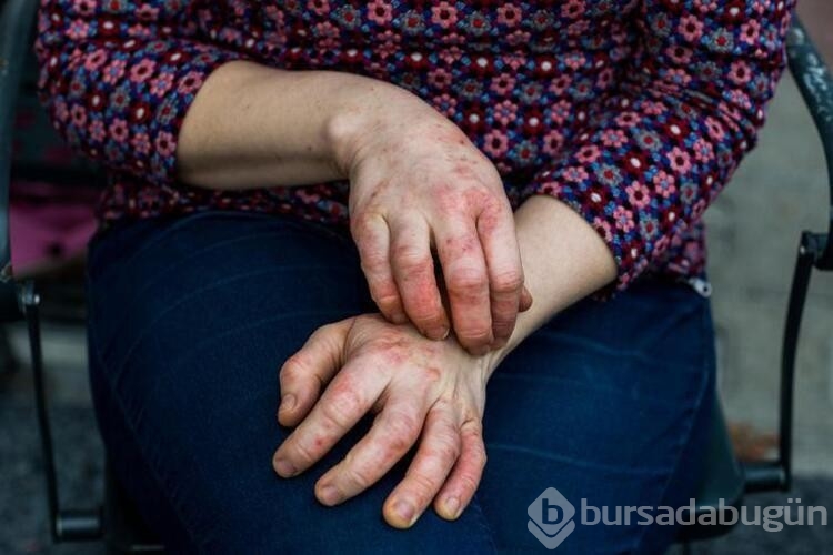 Sonbaharda kuruyan ve daha çok gerilen cildi ve egzamayı rahatlatma yöntemleri
