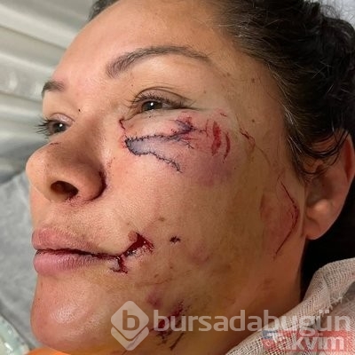 Tuğba Altıntop yaşadığı dehşeti anlattı: Yüzümde 50-60 dikiş var
