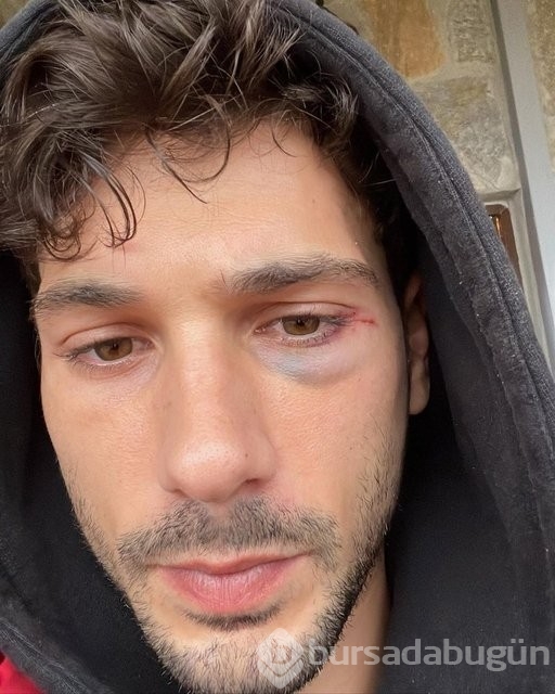Deniz Can Aktaş, gözüne darbe aldı