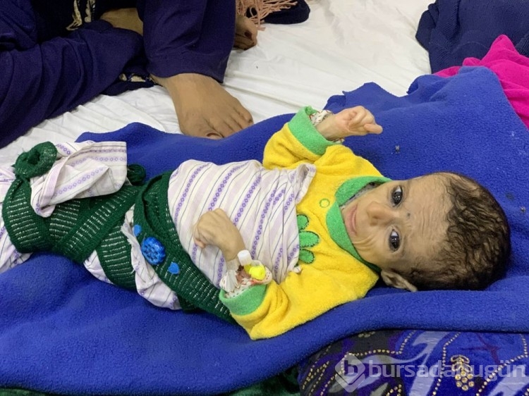 Afgan annelerin bebekleri büyüyemiyor