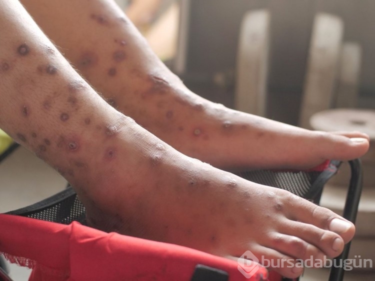 Yeni ölümcül salgın: Candida auris