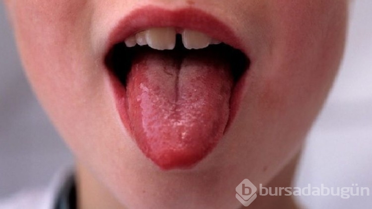 Strep A hastalığı nedir, belirtileri nelerdir?
