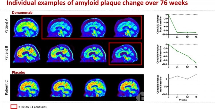 Alzheimer tedavisinde yeni çağ