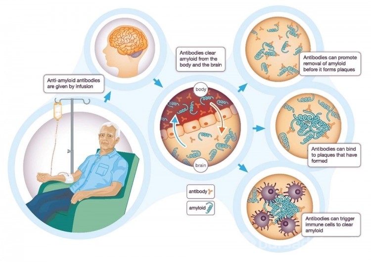 Alzheimer tedavisinde yeni çağ