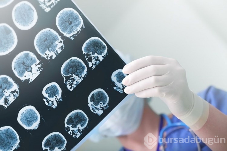 Alzheimer tedavisinde yeni çağ