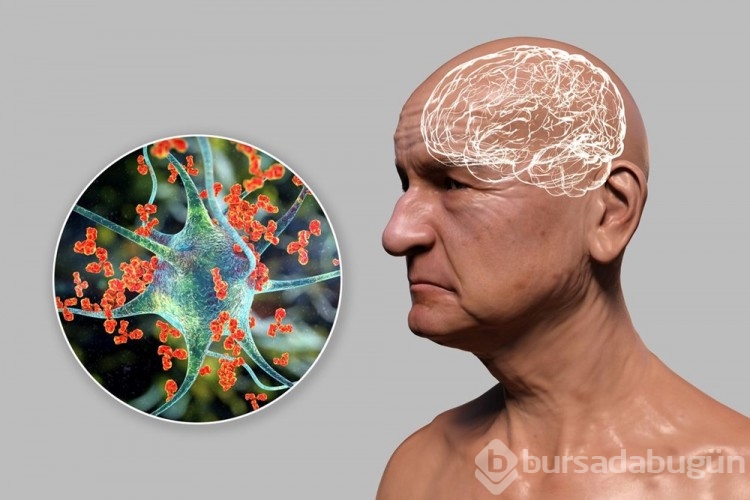 Alzheimer tedavisinde yeni çağ