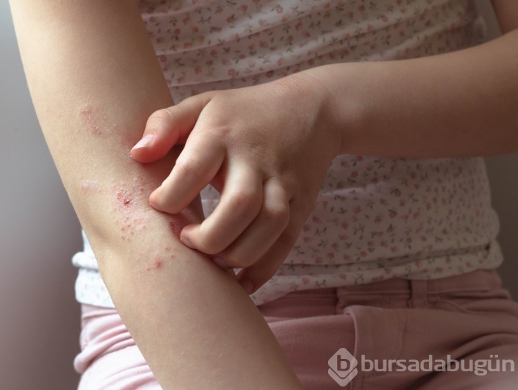 9 soruda bahar alerjiniz olup olmadığını öğrenin 