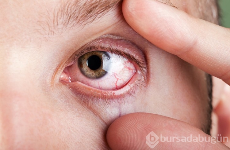 9 soruda bahar alerjiniz olup olmadığını öğrenin 