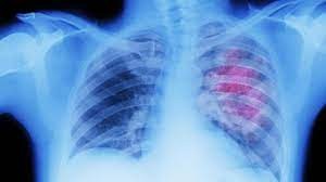 Akciğer kanserinde umut veren gelişme
