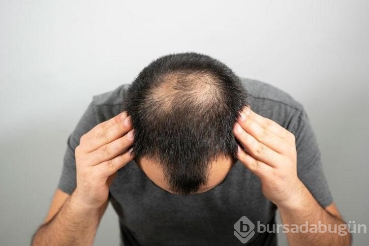 En çok kel erkeğin bulunduğu ülke belli oldu