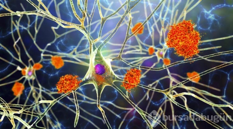 "İlk önemli ipucu": Alzheimer hastalarında beyin hücrelerinin neden öldüğü keşfedildi