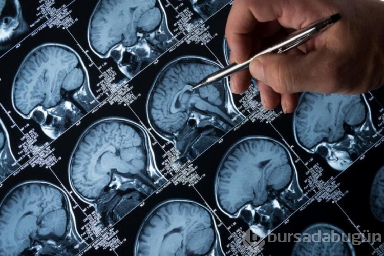 "İlk önemli ipucu": Alzheimer hastalarında beyin hücrelerinin neden öldüğü keşfedildi