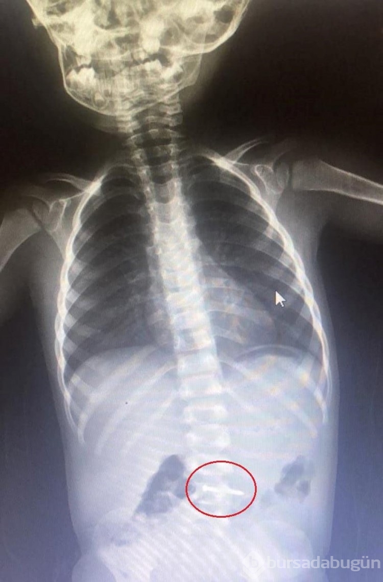 2 yaşındaki Asil yerde bulduğu çiviyi yuttu