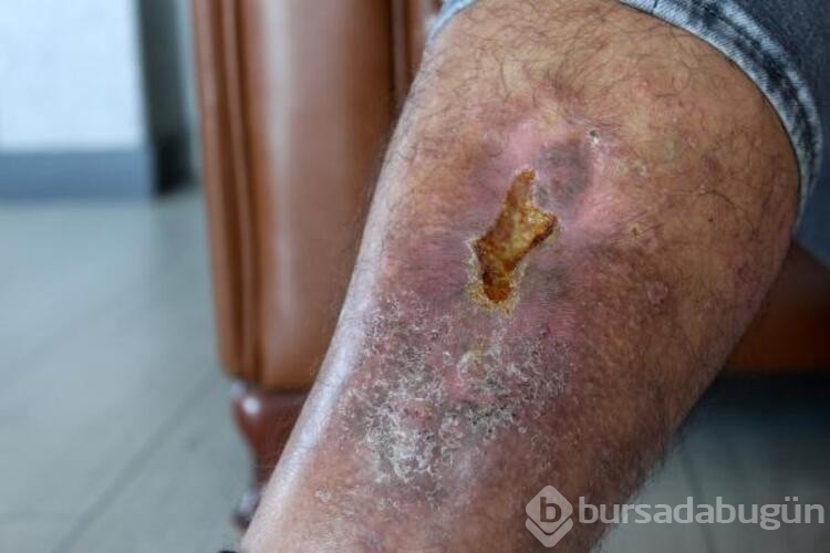 Bacağında unutulan bez parçasıyla 16 yıl yaşadı
