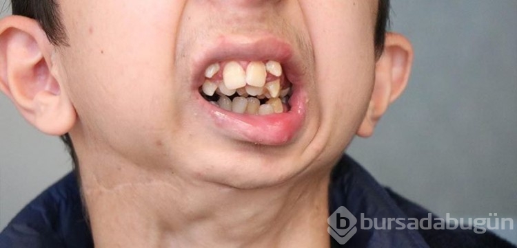 Liseli gencin dramı! Çenesi yok, dişleri üst damağında