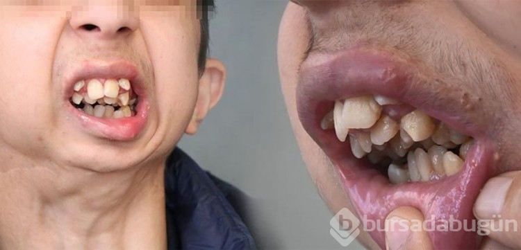 Liseli gencin dramı! Çenesi yok, dişleri üst damağında
