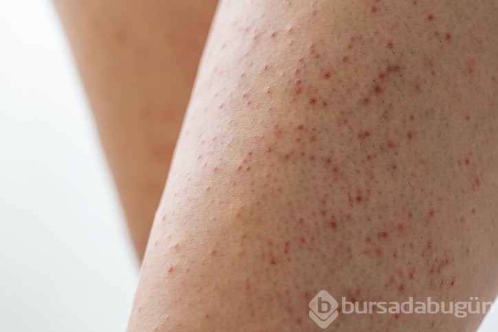 C vitamini depolarının boşaldığının işareti!