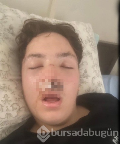 Bursa'da lise çıkışında kavga! 14 yaşındaki gencin burnu kırıldı