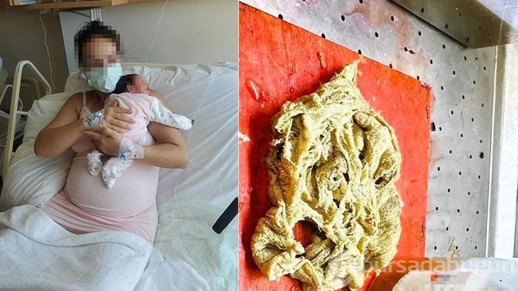 Doğumda annenin vücudunda gazlı bez unutulmasına inceleme
