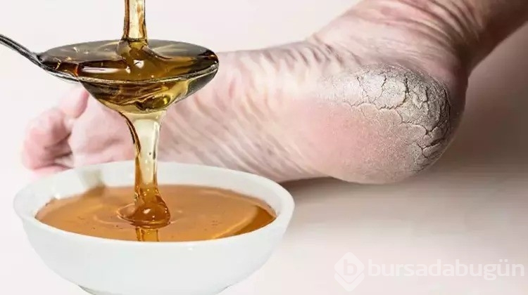 Topukların kurumasına son!