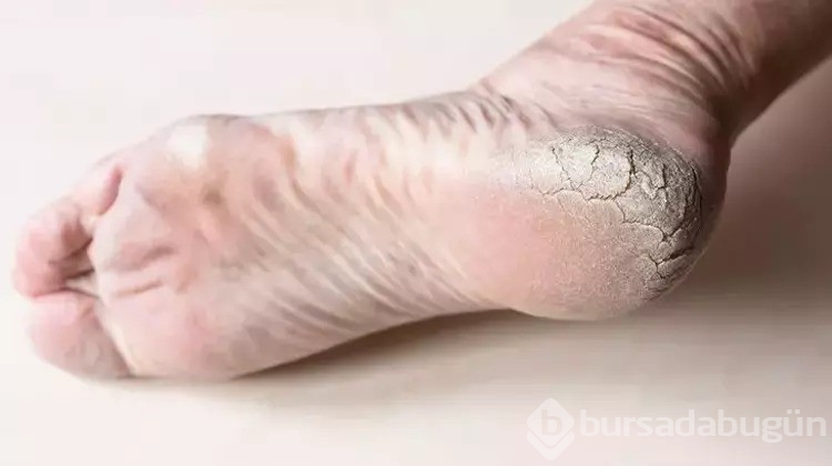 Topukların kurumasına son!