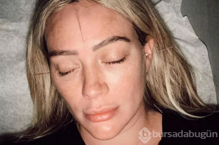 Dördüncü bebeğine hamile olan Hilary Duff akupunktur yaptırdı