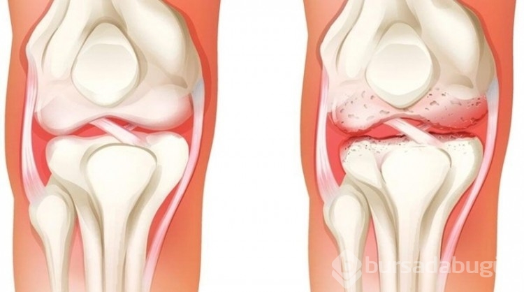 Uzmanı uyardı: Dizlerde ağrı, kireçlenme habercisi olabilir
