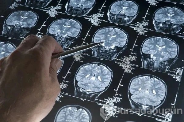 Alzheimer geni tespit edildi: Hastalık tarihe gömülecek!