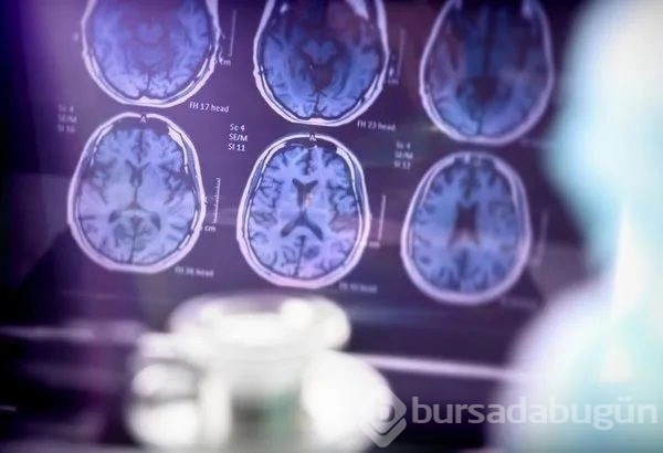 Alzheimer geni tespit edildi: Hastalık tarihe gömülecek!