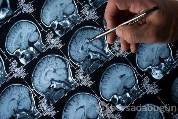 Alzheimer geni tespit edildi: Hastalık tarihe gömülecek!