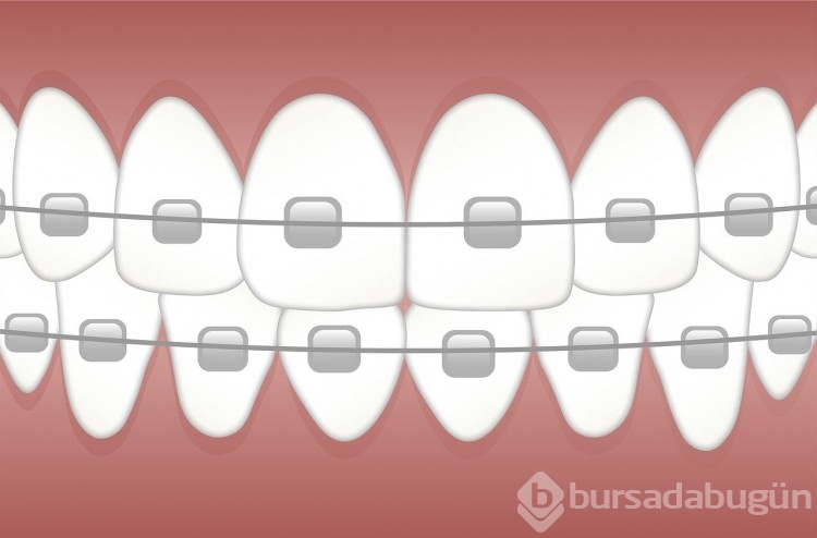 Diş teli ağrısı neden olur? Diş teli ağrısını giderme yöntemleri