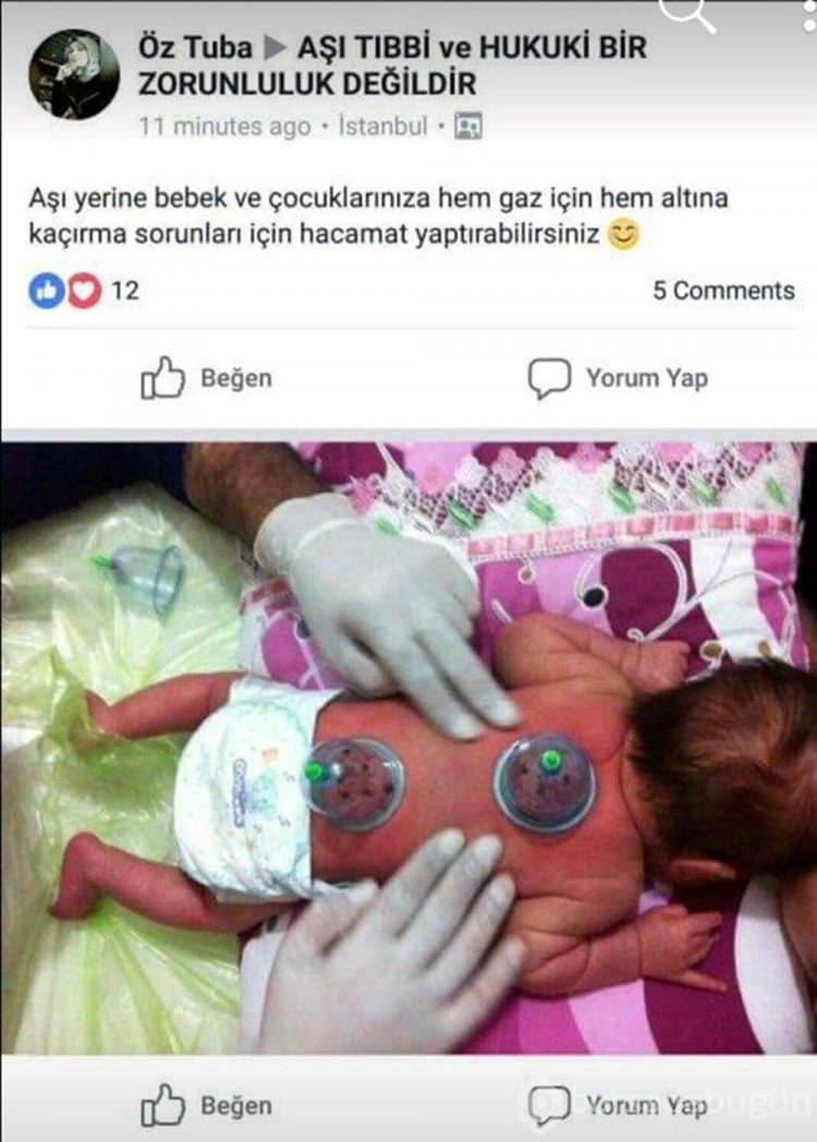 Bebeğe yapılan hacamata soruşturma