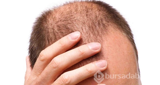 Saç dökülmesi nasıl geçer? Saç dökülmesi en hızlı nasıl durdurulur?