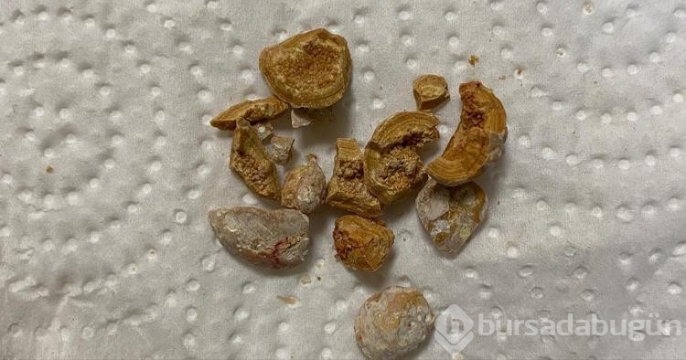 Demli çay böbrek taşı riskini arttırıyor! Uzmanların önerisi ise şunlar...