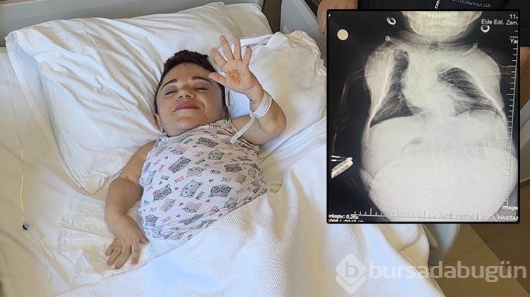 24 kilo ağırlığındaki Nurdan'ın yumurtalıklarından 3 kilo kist çıkarıldı