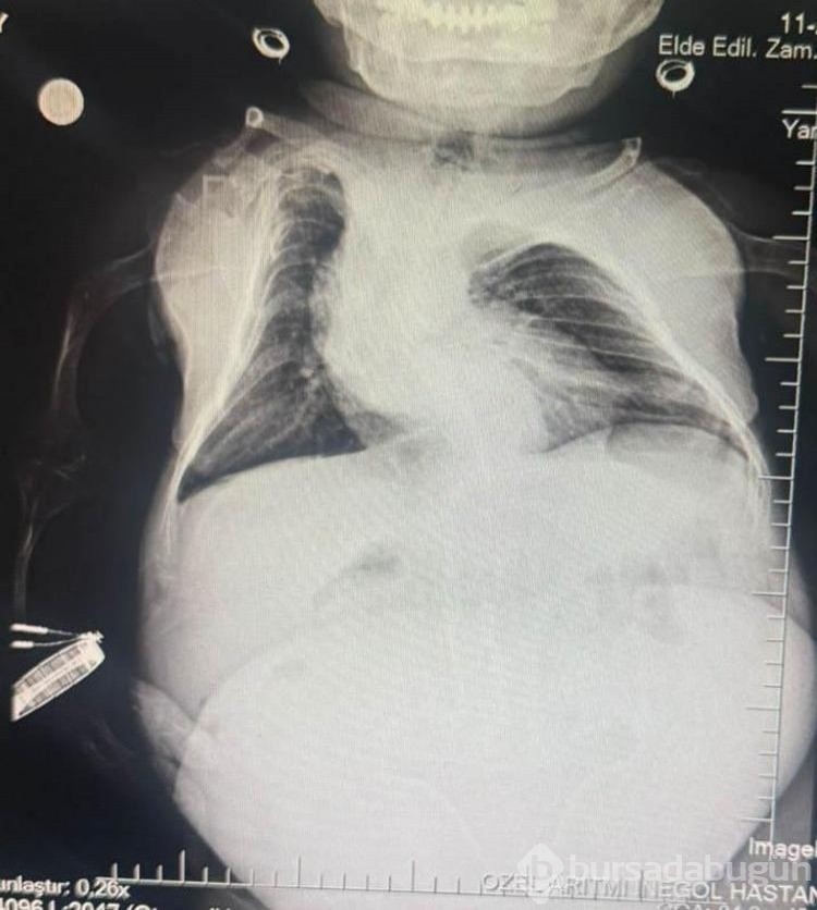 24 kilo ağırlığındaki Nurdan'ın yumurtalıklarından 3 kilo kist çıkarıldı