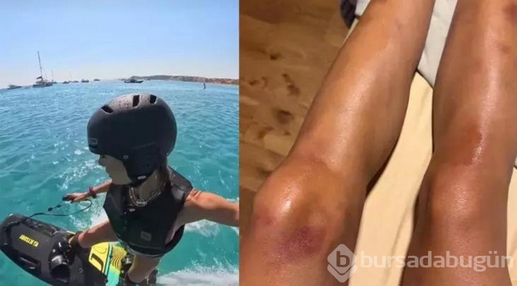 Çağla Şıkel'in yeni hobisi! bacakları mosmor oldu