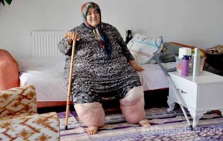 3 yıldır evden çıkamayan fil hastası kadının tekerlekli sandalye sevinci