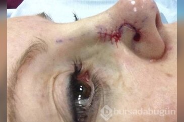 Sivilce sandı ölümden döndü!