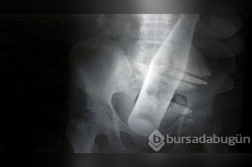Dünyanın en tuhaf röntgen filmleri