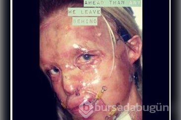 Katie Piper'in yeni yüzü