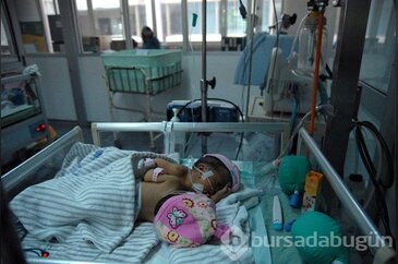 Endonezya'da yapışık ikizler dünyaya geldi