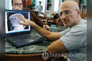 Kafa nakli ile ilgili merak edilenler