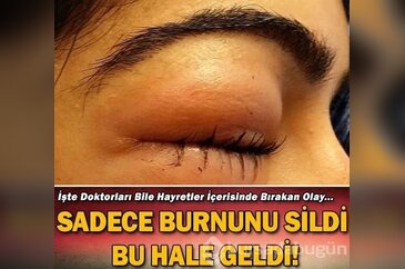 Sadece burnunu sildi bu hale geldi...